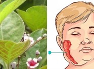 Bài thuốc dân gian chữa quai bị cực kỳ hiệu quả mà không phải ai cũng biết