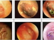 Nhỏ thứ này vào tai thì dù là viêm tai giữa chảy mủ hay thối tai cũng khỏi ngay sau 2 ngày, không tái phát