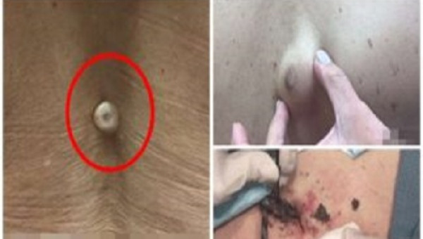 Tưởng đinh vít cắm vào lưng, rút ra thì mới hoảng hồn lảo đảo suýt ngã vì choáng