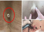 Tưởng đinh vít cắm vào lưng, rút ra thì mới hoảng hồn lảo đảo suýt ngã vì choáng