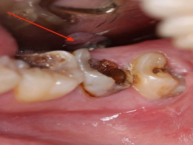 Sâu răng, sưng nướu, ê buốt không ngủ được chỉ cần ngậm thứ này là sẽ dứt