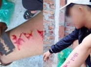 Chàng trai khắc tên người yêu lên tay vì thất tình