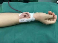 Hình ảnh gây sốc: Tai mọc trên cánh tay người!