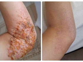 Tôi đã thoát khỏi sự giày vò 10 năm của bệnh eczema như thế nào