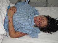 Bệnh viêm não mô cầu cực nguy hiểm lại xuất hiện ở Hà Nội