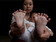Hi hữu em bé 3 tháng tuổi có tổng cộng 31 ngón tay và ngón chân