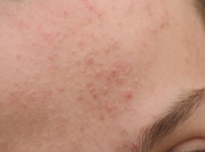 Nếu không biết những điều sau, mụn ẩn có thể bám theo bạn suốt đời