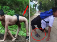 Chứng bệnh kỳ quái nhất lịch sử khiến 80.000 người đang phải… đi bằng 4 chân