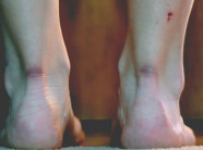 Cuối cùng khoa học cũng tìm ra cách trị thương mà KHÔNG để lại sẹo