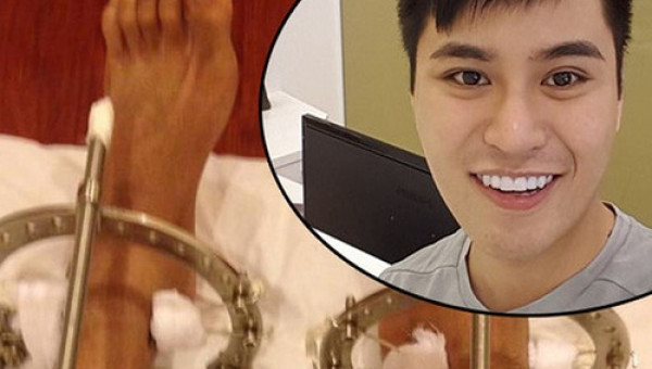 Chàng trai phẫu thuật kéo chân từ 1m67 lên 1m76: Vẫn cõng được người yêu như thường!