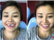 Bà mẹ đơn thân dũng cảm “đập đi xây lại” 20 chiếc răng để đón Tết