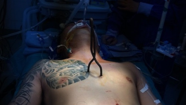 Hy hữu: Thanh sắt xiên cá đâm thủng 6 lỗ trên tim, vẫn sống