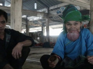 Xót xa nhìn cụ bà ở Hà Giang khổ sở vì chiếc lưỡi khổng lồ