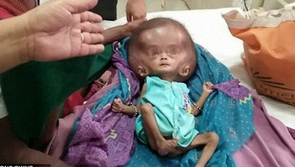 Em bé đáng thương trông giống người ngoài hành tinh với chiếc đầu phình to