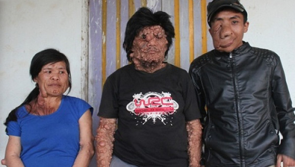 Những cơn đau tột cùng của 3 cha con mang căn bệnh 'mặt quỷ' quái ác