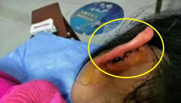 Giáo viên chủ nhiệm véo rách tai học sinh lớp 2 vì làm sai bài tập về nhà