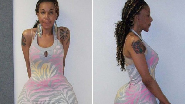 Bác sĩ chuyển giới bơm keo vào mông khiến bệnh nhân tử vong