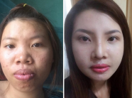 Sự đổi thay không tưởng của "Thị Nở tái thế" sau phẫu thuật