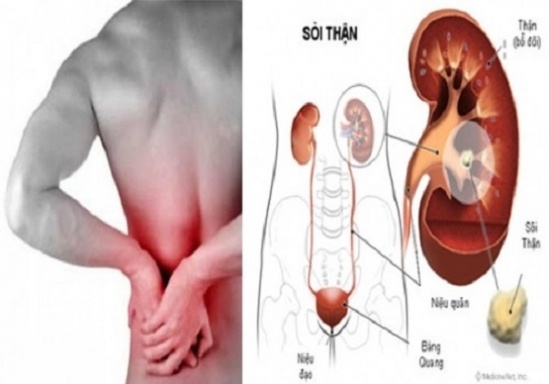 sỏi thận